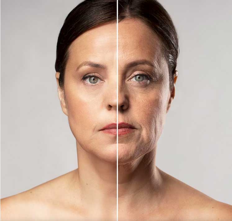 Antes - después de la aplicación de tensores faciales