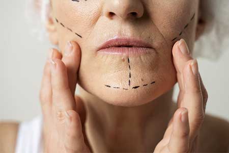 Líneas marcadas para tratamiento con tensores faciales en mejillas y pómulo